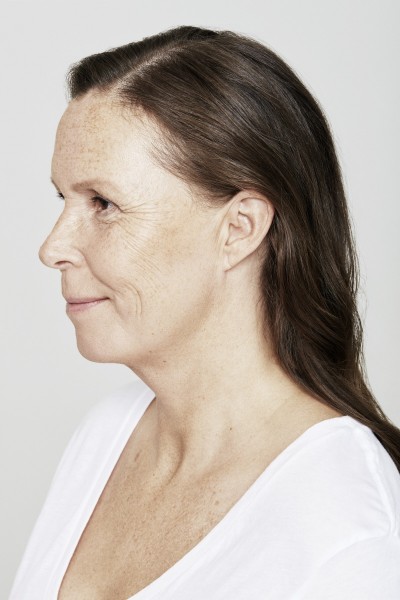 restylane Borås