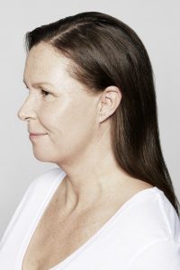 restylane skinbooster borås