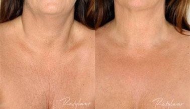 decolletage behandling rynkor